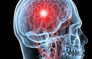 L'Ictus és una malaltia cerebral que ocorre quant un vas que porta sang al cervell es trenca o s'obstrueix per un coàgul. FOTO: Cedida