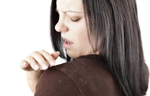 Cal raspallar els cabells cada dia per eliminar les escates de caspa