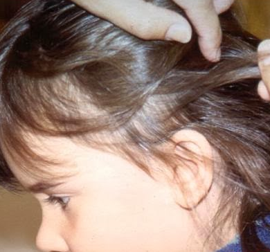 Una mare cerca polls al cap de la seva filla FOTO: Cedida