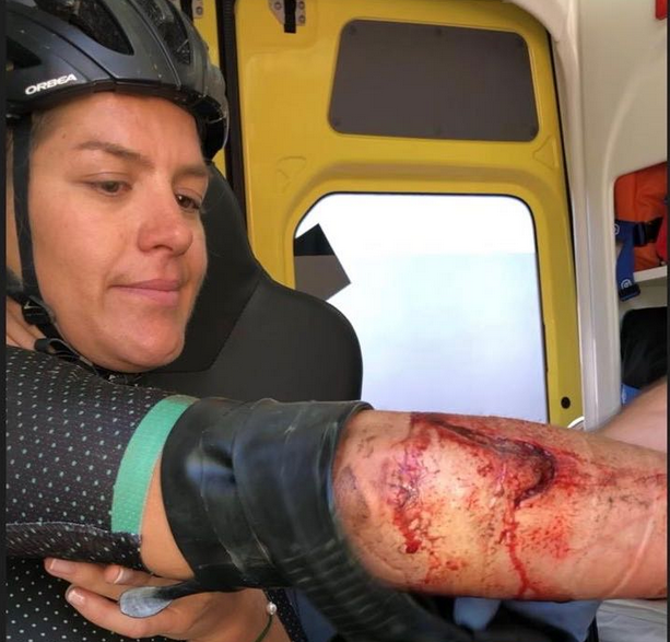 Sandra Jordà amb la ferida que li va provocar la trampa. FOTO: Cedida