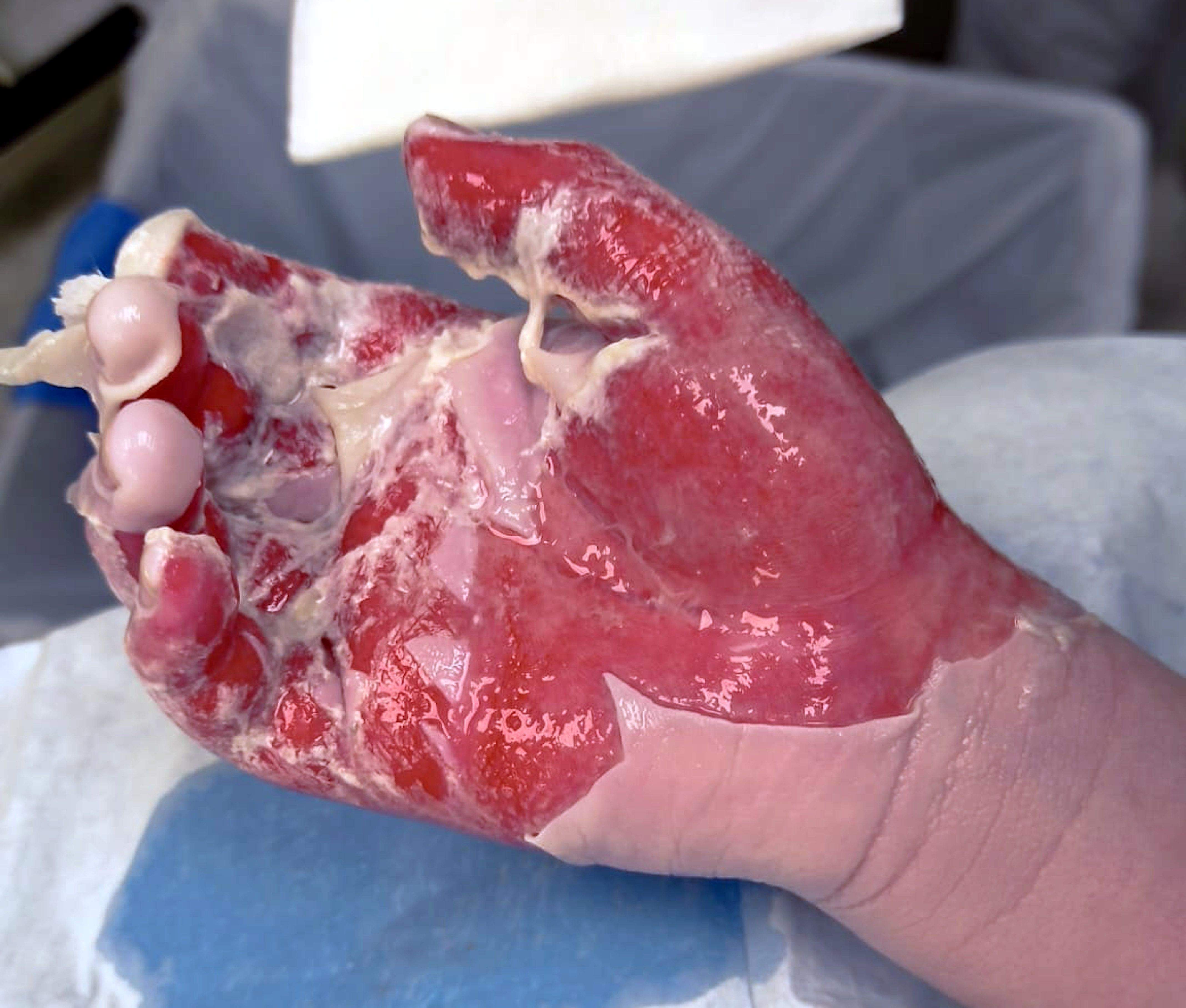 Així va quedar la mà del Marc després de la cremada FOTO: Cedida