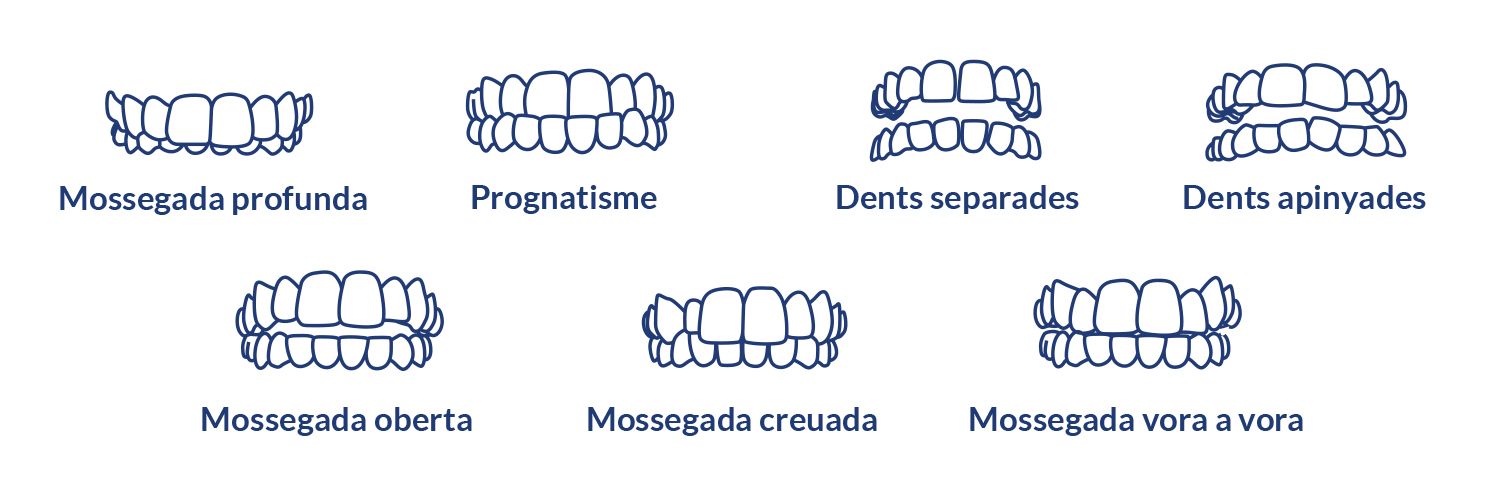 Tipus Mossegades clinica dental grup policlinic ortodoncia invisible CAT